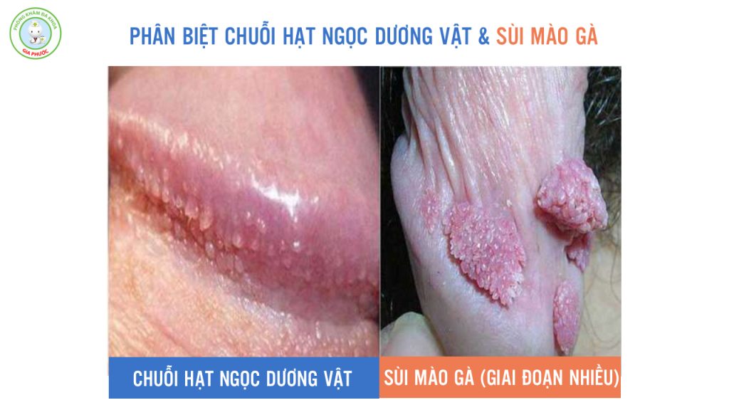 Hình ảnh phân biệt chuỗi hạt ngọc dương vật và sùi mào gà