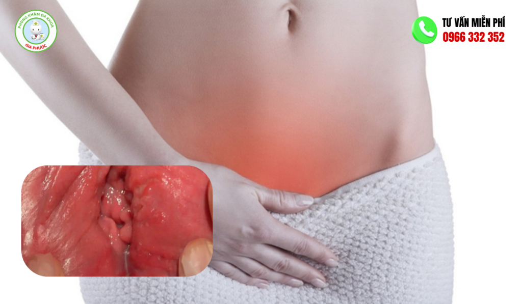 Thịt Dư Ở Mép Vùng Kín: Nguyên Nhân, Cách Điều Trị Hiệu Quả 2 Hình ảnh thịt dư ở mép vùng kín