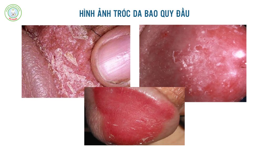 Tróc Da Bao Quy Đầu: Nguyên Nhân, Mức Độ Nguy Hiểm & Cách Xử Lý Chuẩn Y Khoa 2 Hình ảnh tróc da bao quy đầu - một số trường hợp điển hình