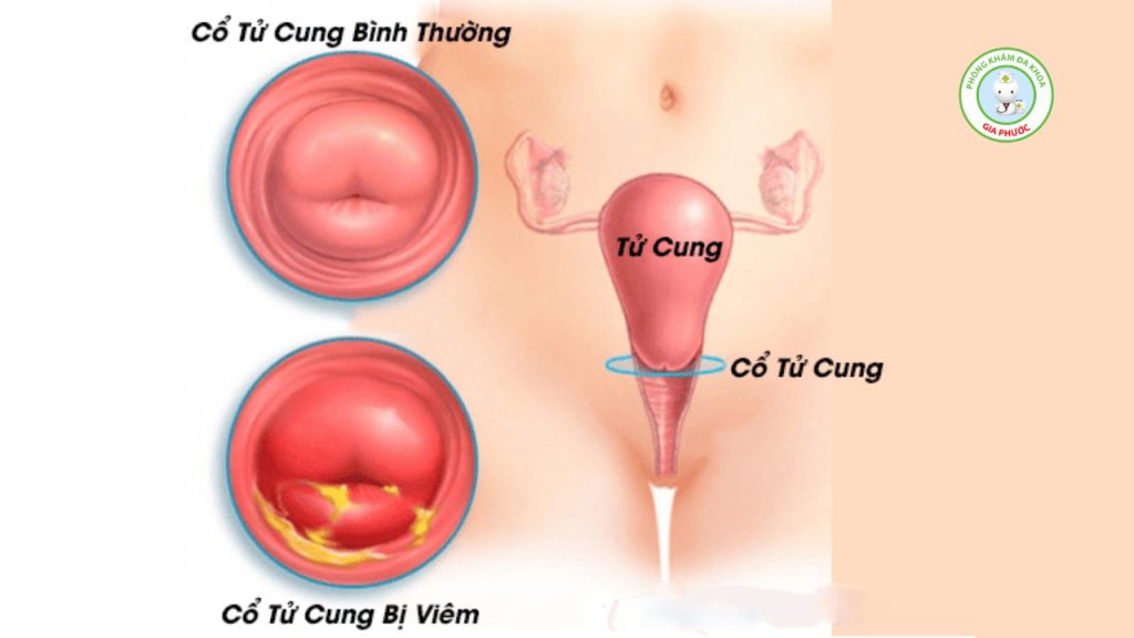 Hình ảnh nhận biết viêm cổ tử cung là gì?