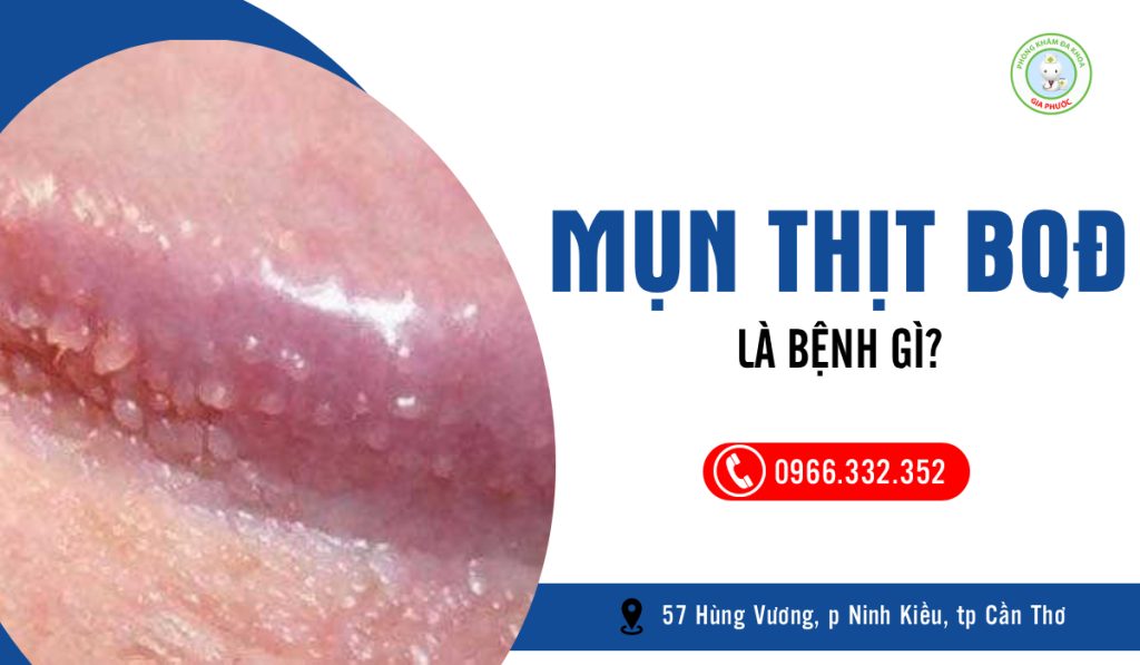 Mụn thịt bao quy đầu là bệnh gì?