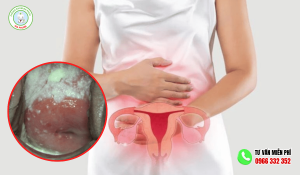 Nấm Candida Ở Vùng Kín Nữ