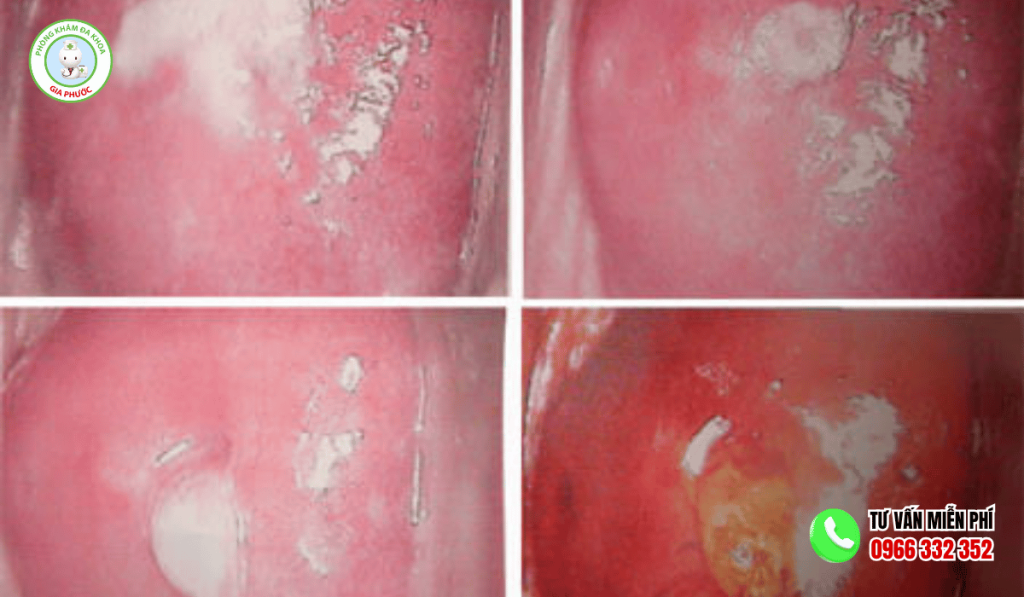 Nấm Candida Ở Vùng Kín Nữ Dấu Hiệu Và Cách Trị Dứt Điểm 3 Nấm Candida Ở Vùng Kín Nữ