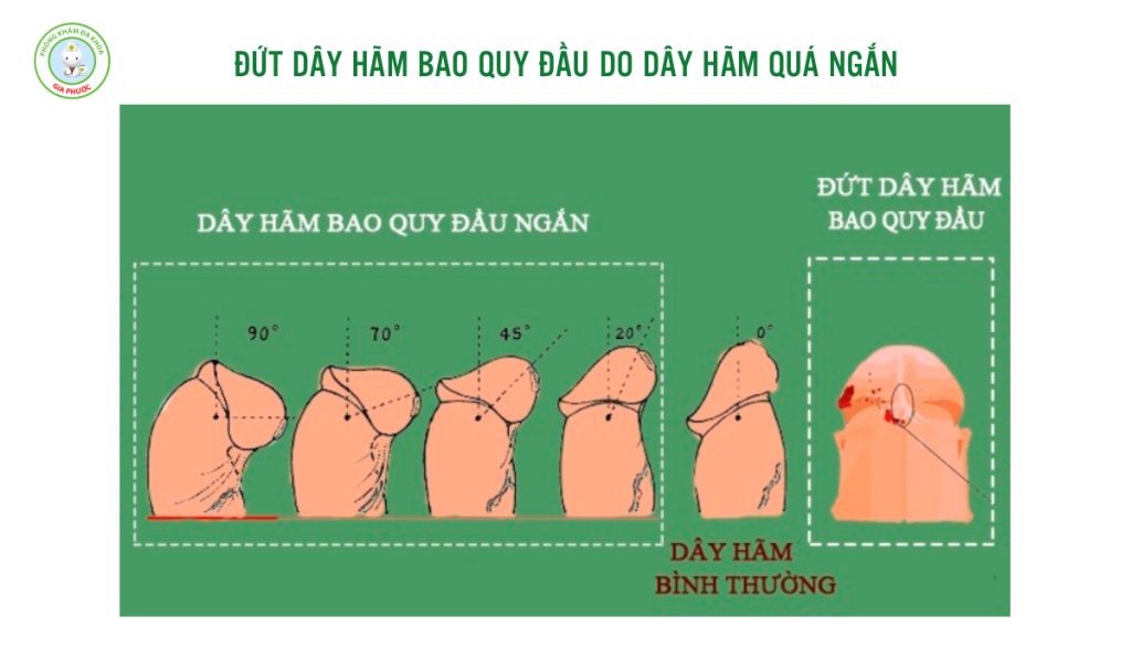Đứt Dây Hãm Bao Quy Đầu Xử Lý Như Thế Nào An Toàn Chuẩn Y Khoa 2 Dây hãm quá ngắn hoặc dày bẩm sinh có thể là nguyên nhân gây đứt dây hãm bao quy đầu