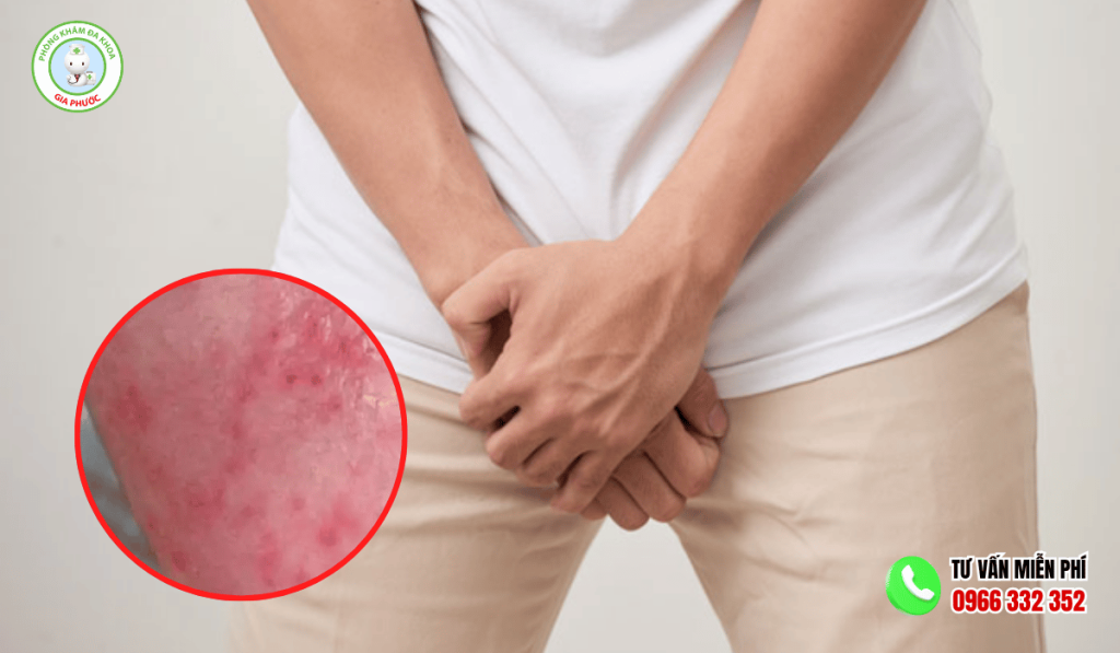 Nổi Chấm Đỏ Trên Quy Đầu Bệnh Gì? Cách Xử Lý Hiệu Quả 1 Nổi Chấm Đỏ Trên Quy Đầu Bệnh Gì
