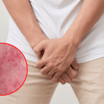 Nổi Chấm Đỏ Trên Quy Đầu Bệnh Gì