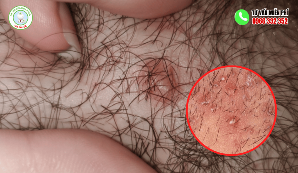Nổi mụn ở vùng lông mu nữ