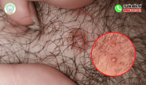 Nổi mụn ở vùng lông mu nữ