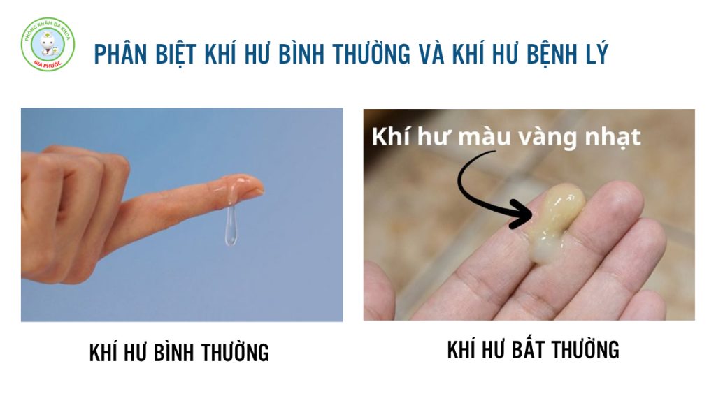 Giải Đáp Thắc Mắc: Vùng Kín Bị Ngứa Và Khí Hư Có Mùi Hôi Là Bệnh Gì? 3 Hình ảnh phân biệt khí hư bình thường và khí hư bệnh lý