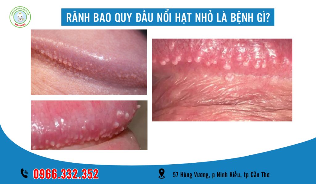 Rãnh Bao Quy Đầu Nổi Hạt Nhỏ Bệnh Gì? Cách Xử Lý Hiệu Quả Chuẩn Y Khoa 1 Rãnh bao quy đầu nổi hạt nhỏ bệnh gì?