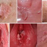 Thịt dư ở mép vùng kín