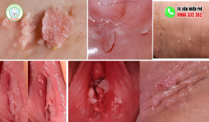 Thịt dư ở mép vùng kín