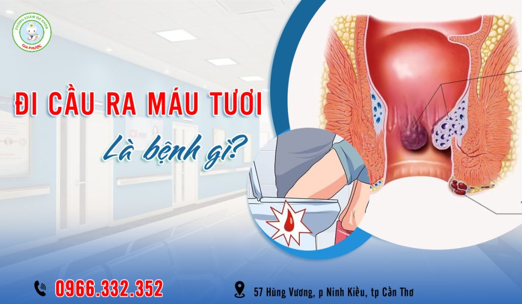 Biểu hiện đi cầu ra máu tươi là bệnh gì?