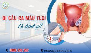 Biểu hiện đi cầu ra máu tươi là bệnh gì?