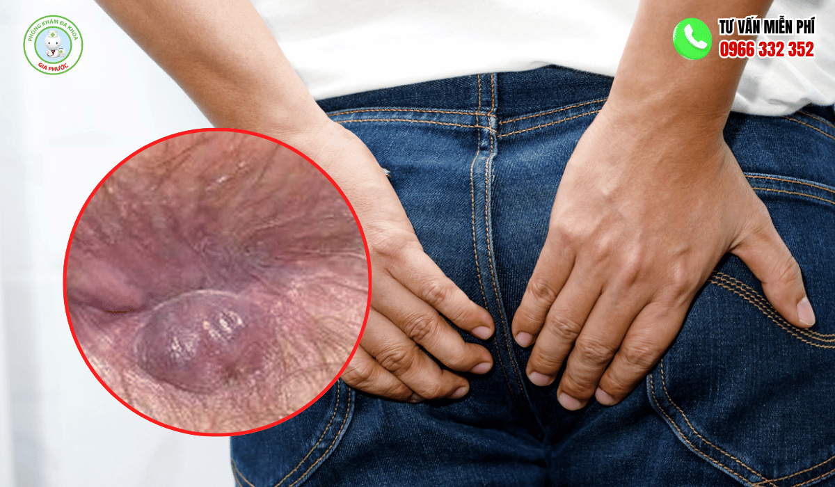 Hình ảnh trĩ ngoại đồ 1