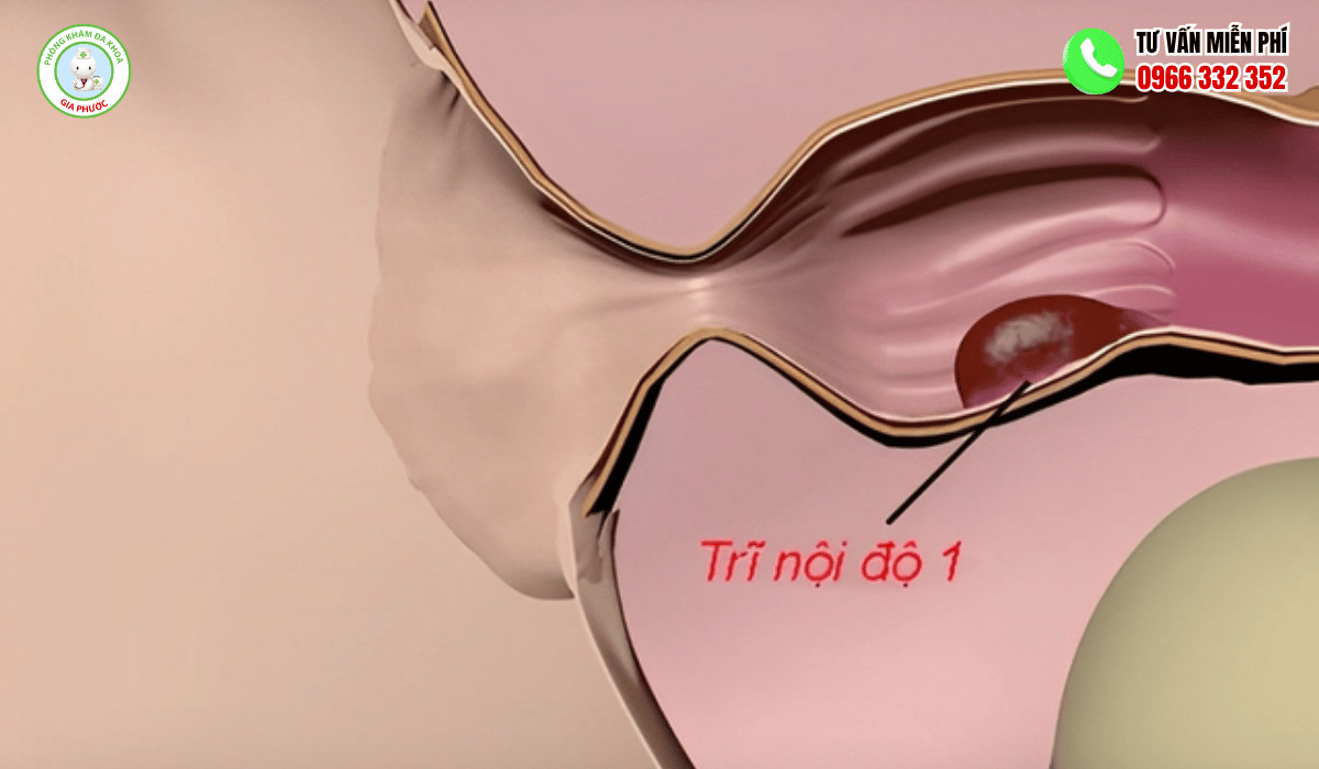 Trĩ Nội Độ 1 Có Tự Khỏi Không? Giải Đáp Y Khoa 2 hình ảnh trĩ nội độ 1