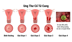 hình ảnh ung thử cổ tử cung