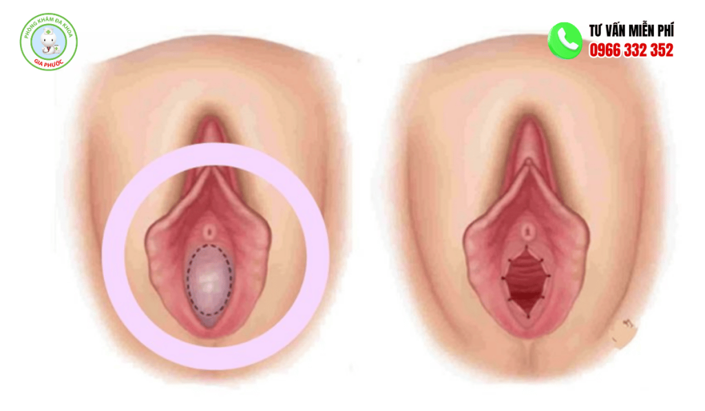màng trinh có dễ khách không