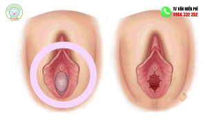 màng trinh có dễ khách không