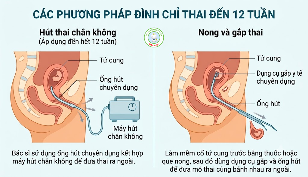 Phương pháp đình chỉ thai có thể được chỉ định cho thai 12 tuần