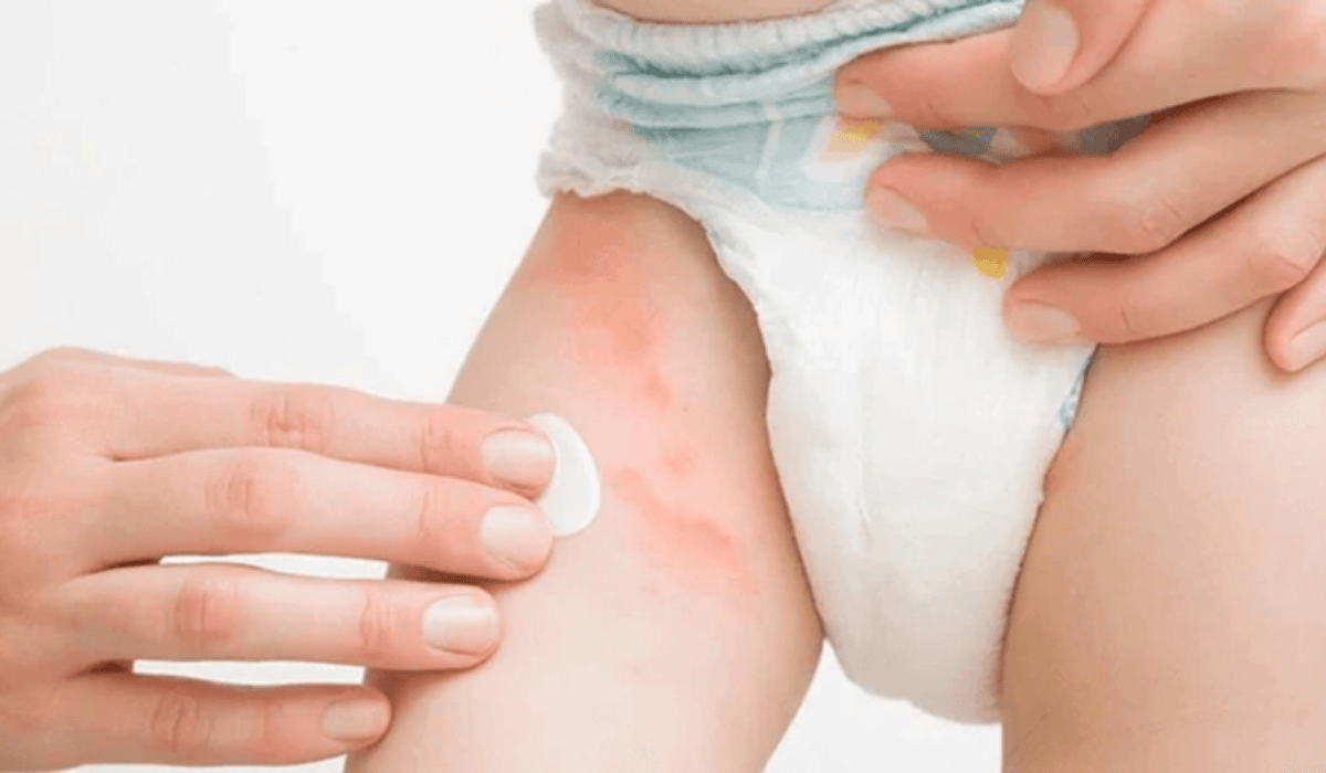 Trẻ Bị Hăm Ở Vùng Kín Bé Trai