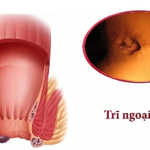 Trĩ Ngoại Độ 1 Có Tự Khỏi Không