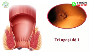 Trĩ Ngoại Độ 1 Có Tự Khỏi Không