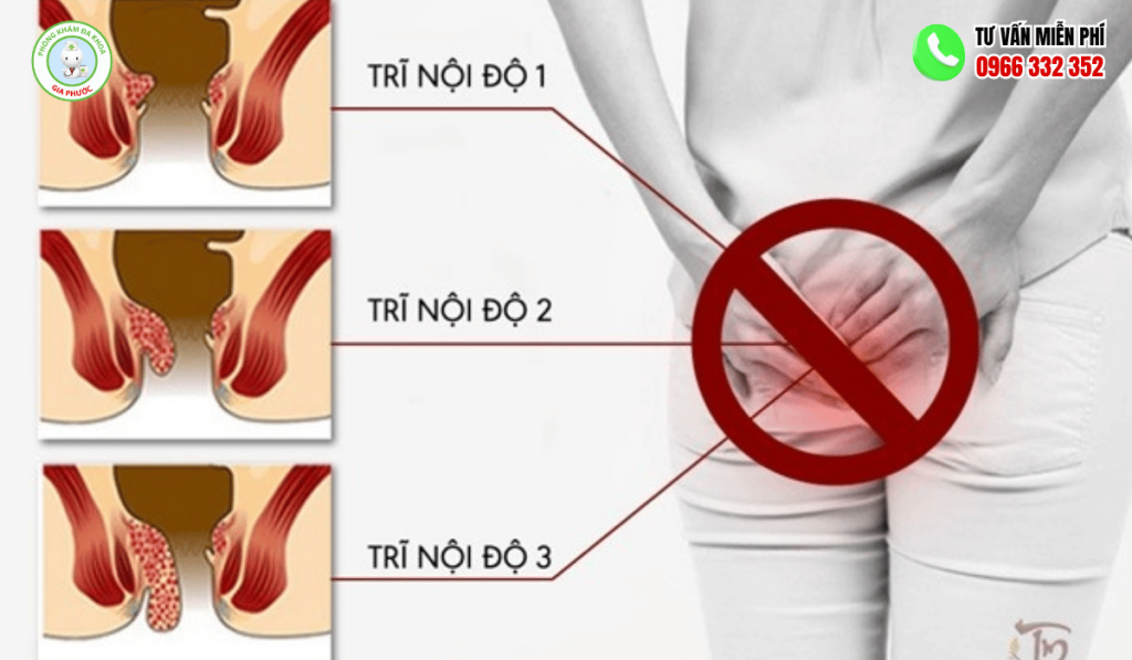 Trĩ Nội Độ 1 Có Tự Khỏi Không? Giải Đáp Y Khoa 1 Trĩ Nội Độ 1 Có Tự Khỏi Không
