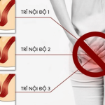 Trĩ Nội Độ 1 Có Tự Khỏi Không