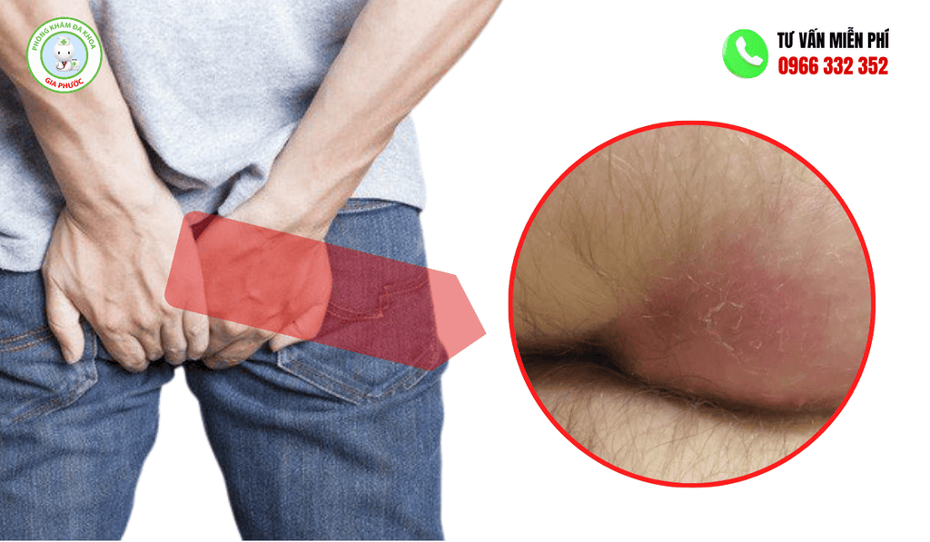 Vành hậu môn có cục cứng